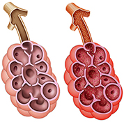 Aspergiosis