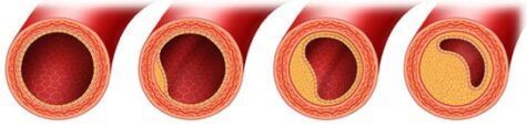 Etapas de Atherosclerosis