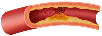 Atherosclerosis avanzado