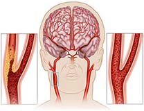 arteroscleorosis