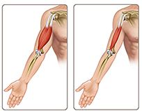 Healthy and atrophic muscles
