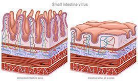 Intestinal villus of a celiac