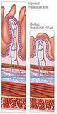 Small intestine villus in Celiac