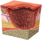Carcinoma