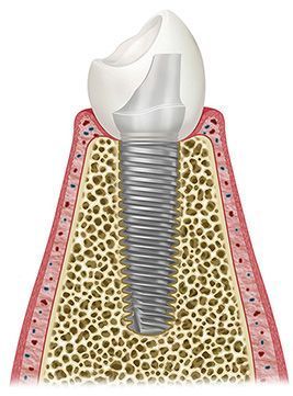 Implant screw