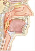 Tumor de Orofaringe