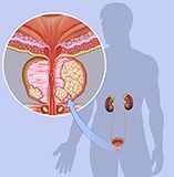 Cáncer de próstata