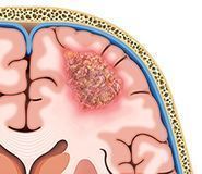 Tumor cerebral Glioblastoma