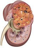 Tumor de riñón