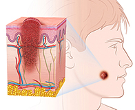 Melanoma en espalda