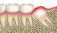 Wisdom tooth