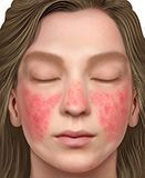 lupus eritematosos