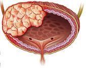 Cáncer de vejiga