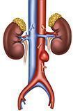 Aneurismas aorta Abdominal Sacular