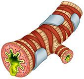 Bronquiolo bronquitis