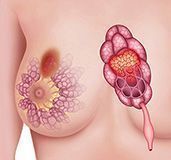 Carcinoma mamario