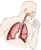 Irritación de bronquios