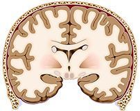 Corte coronal del cerebro