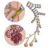 Emphysema y Bronquitis