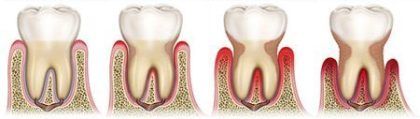 Estadios de periodontitis