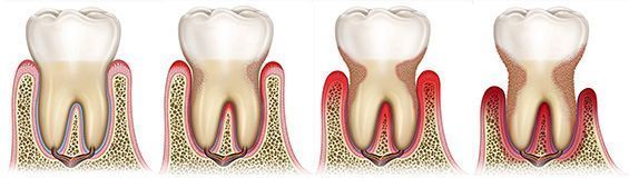 Estadios de periodontitis