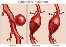 Tipos de aneurismas